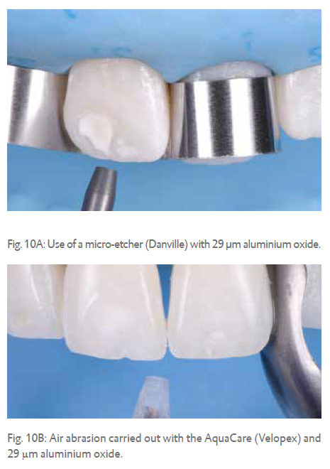 Fig. 10A: Use of a micro-etcher (Danville) with 29  m aluminium oxide.  Fig. 10B: Air abrasion carried out with the AquaCare (Velopex) and 29  m aluminium oxide.